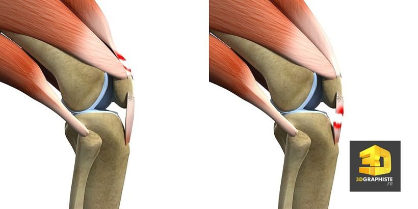 Illustration 3d médicale déchirure muscles genoux