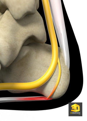 Illustration médicale irritation du nerf 3D