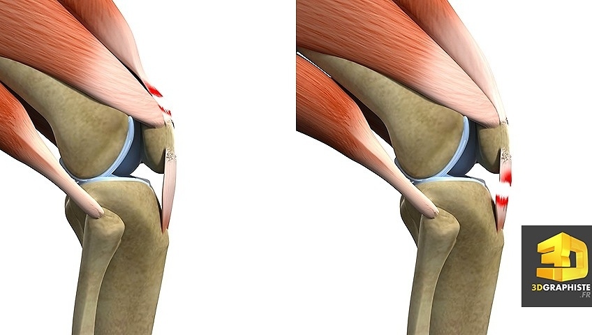 illustration 3d medicale dechirure muscles genoux