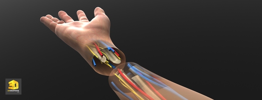 Greffe de la main - Illustration 3D médicale